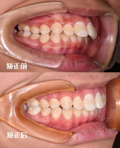 上海龅牙矫正怎么选？效果靠谱吗？费用多少？-图1