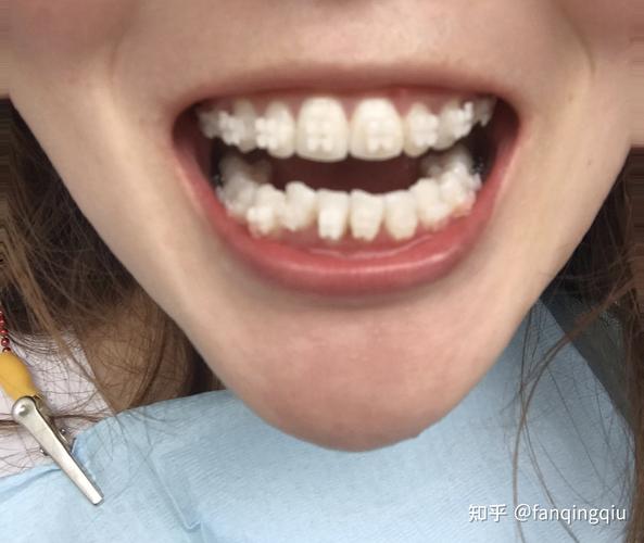 27岁做牙齿矫正-图1 27岁做牙齿矫正-图1