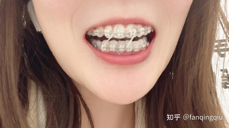 27岁做牙齿矫正-图3 27岁做牙齿矫正-图3