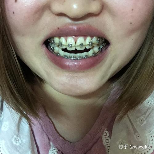 27岁做牙齿矫正-图2 27岁做牙齿矫正-图2