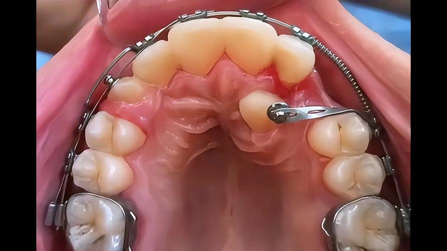 北京隐形牙齿矫正哪家好?效果如何?-图3 北京隐形牙齿矫正哪家好?效果如何?-图3