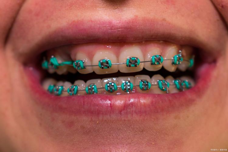 维多利亚牙齿矫正-图3