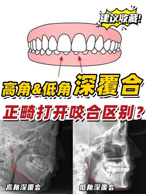 牙齿咬合不齐怎么矫正？有哪些科学有效的矫正方法？-图3