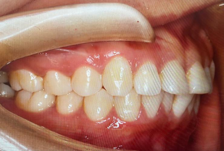 牙齿矫正拔牙会引发哪些不可逆危害？-图2