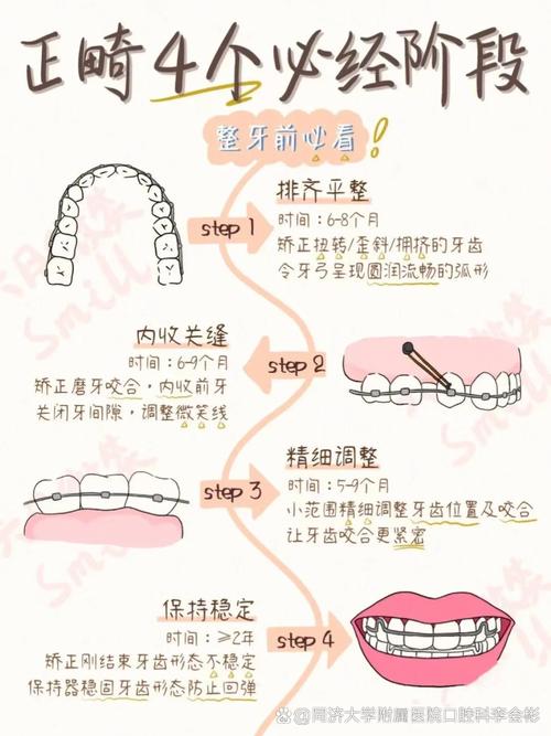 牙齿矫正的过程是怎样的?包含哪些关键步骤和科学原理?-图3 牙齿矫正的过程是怎样的?包含哪些关键步骤和科学原理?-图3