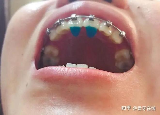 牙齿矫正平导图片能看出效果吗?作用有哪些?-图2 牙齿矫正平导图片能看出效果吗?作用有哪些?-图2