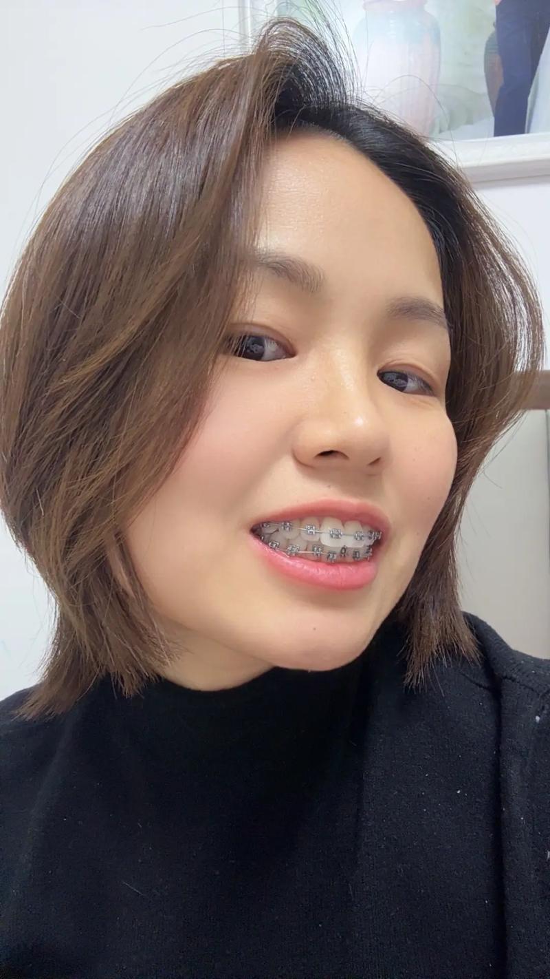 二十多岁矫正牙齿,还来得及吗?-图1 二十多岁矫正牙齿,还来得及吗?-图1