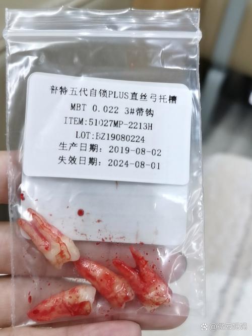 矫正牙齿拔四颗牙，真的有必要吗？会有啥影响？-图1