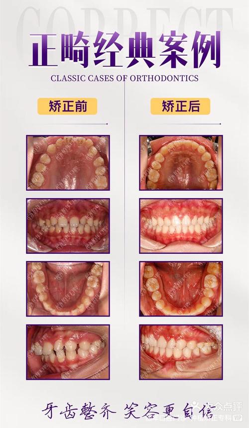 北京牙齿隐形矫正-图3