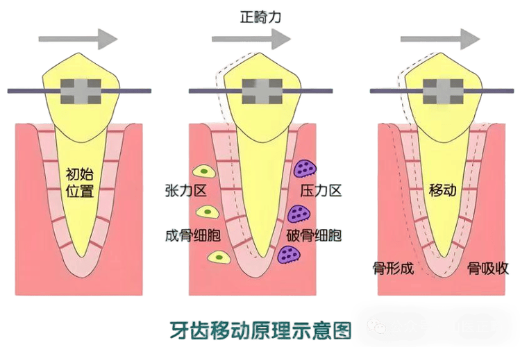 牙齿矫正器如何移动牙齿的原理是什么？-图1