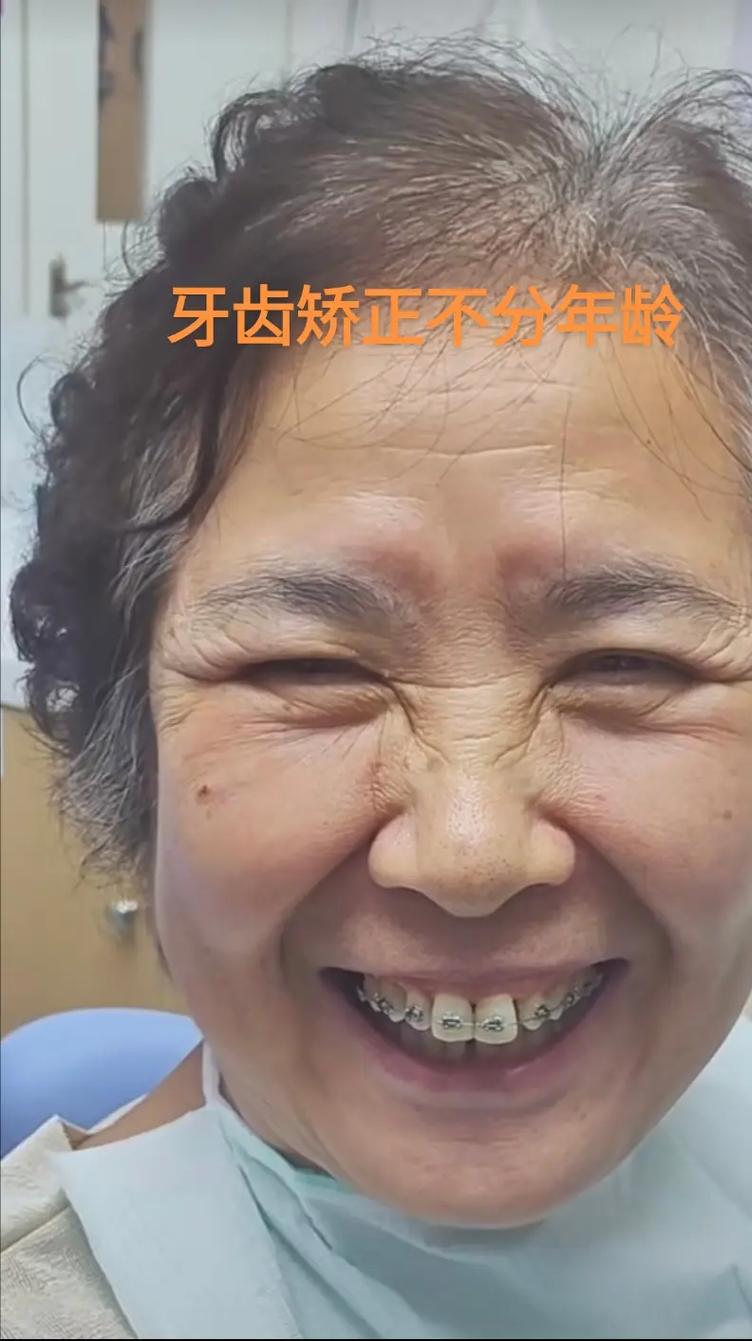 小孩矫正牙齿的最佳年龄是几岁？-图3