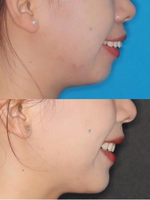 矫正后的牙齿图片能展示真实效果吗？参考价值高吗？-图1