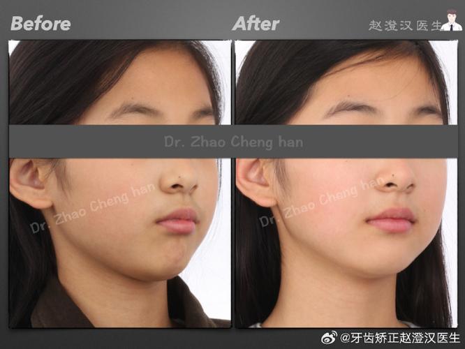 牙齿矫正真有后遗症？具体有哪些表现？-图2