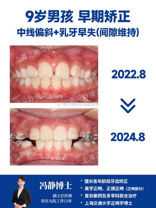 矫正牙齿中线不齐-图1 矫正牙齿中线不齐-图1