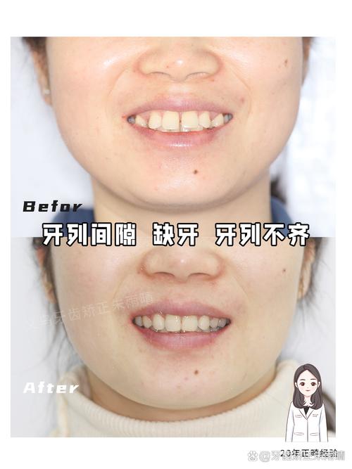 矫正牙齿中线不齐-图2 矫正牙齿中线不齐-图2