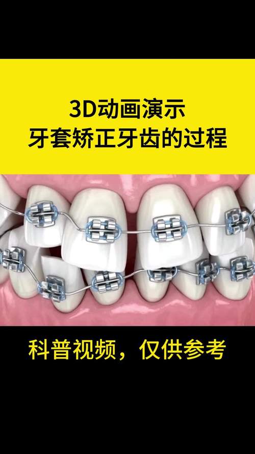 牙齿矫正过程视频，真实过程到底如何呢？-图1