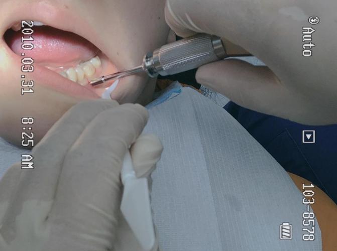 牙齿矫正过程视频，真实过程到底如何呢？-图2