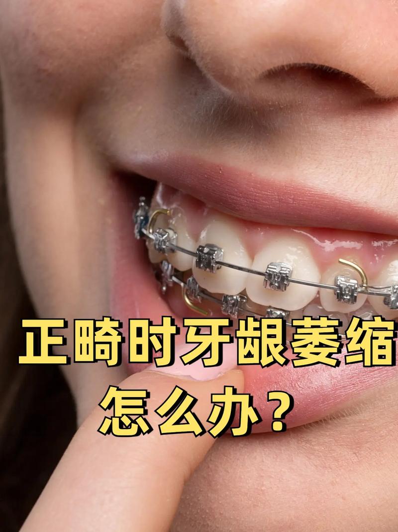 矫正牙齿牙龈萎缩-图1