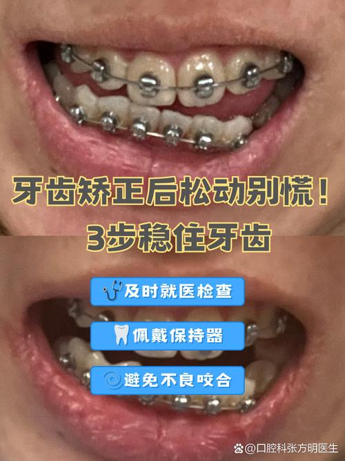 牙齿矫正真的会让牙齿松动吗？矫正期间和矫正后会怎样？-图3