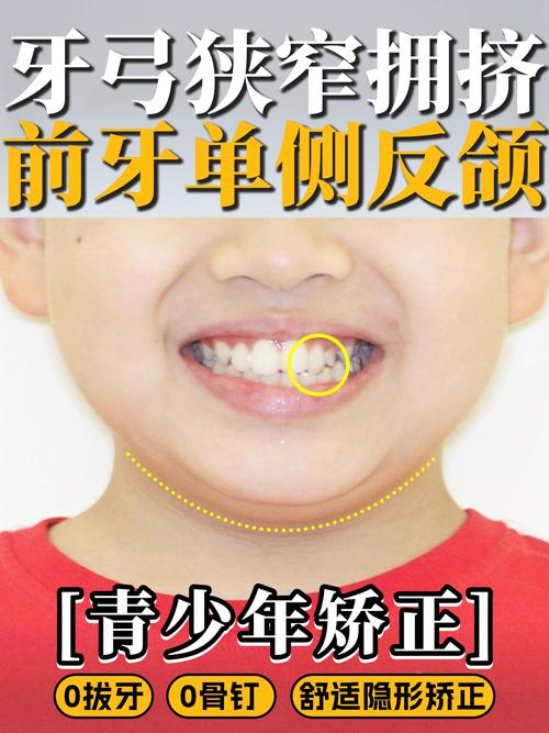儿童牙齿反颌矫正-图1