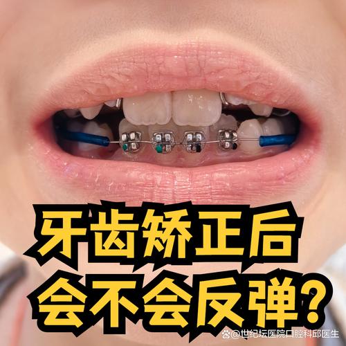 牙齿矫正先消炎-图2