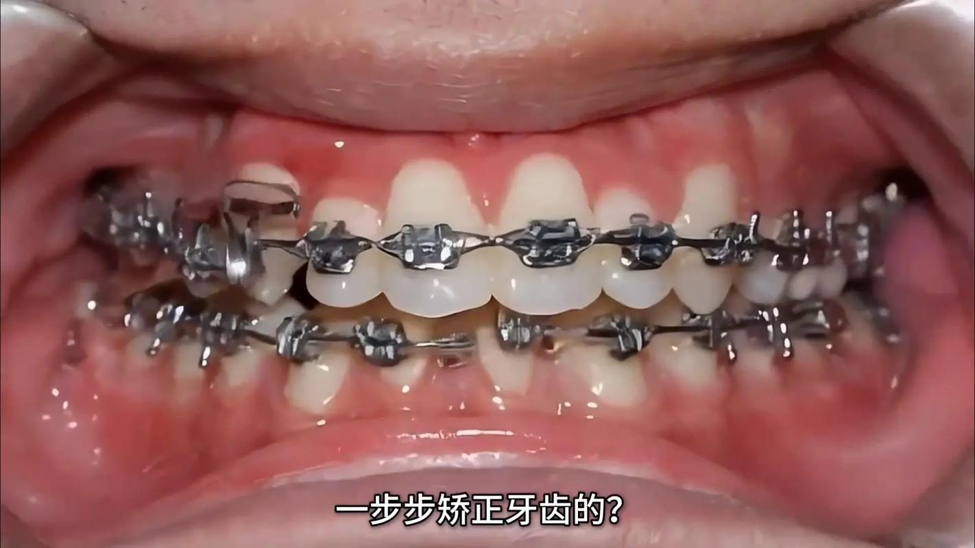 游离钩牙齿矫正效果好吗？安全吗？适合哪些人？-图2