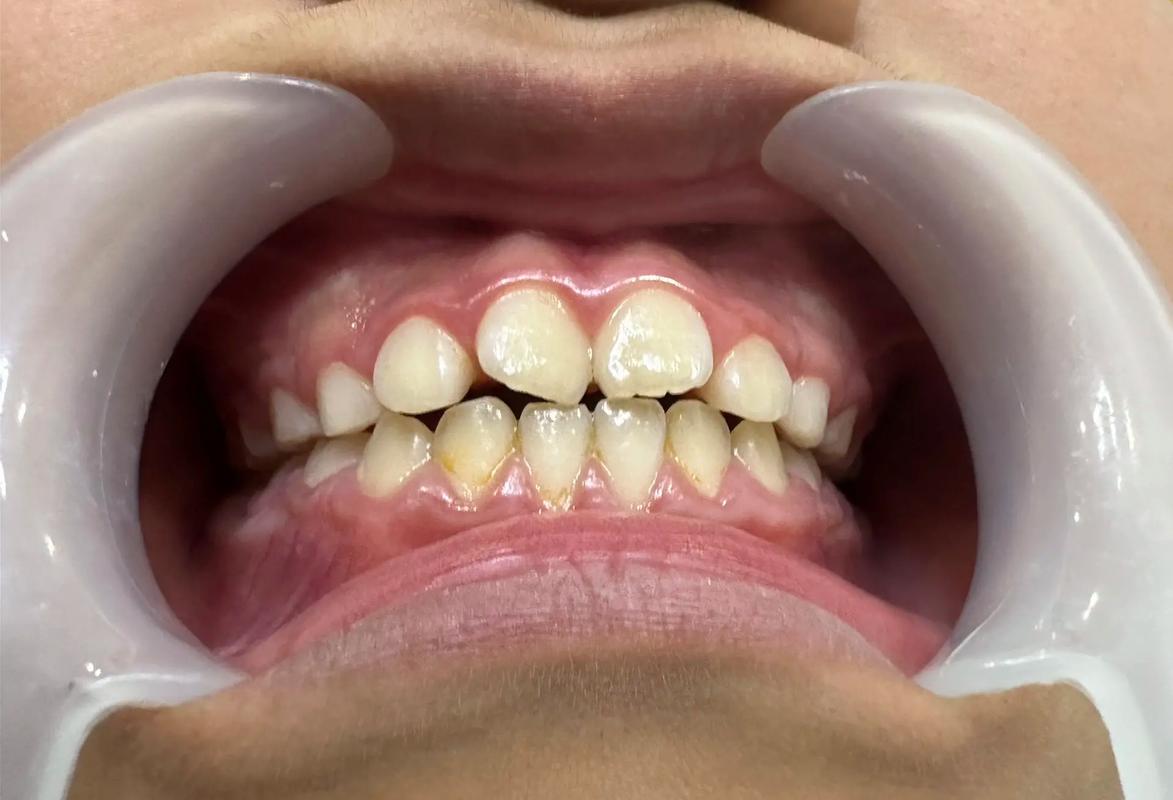 矫正牙齿2-4个月能完成矫正吗？-图1