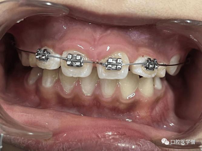牙内侧牙齿矫正-图2 牙内侧牙齿矫正-图2