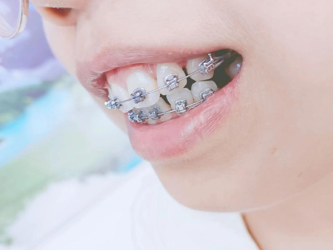 矫正牙齿戴面罩，究竟对矫正有何帮助？-图2