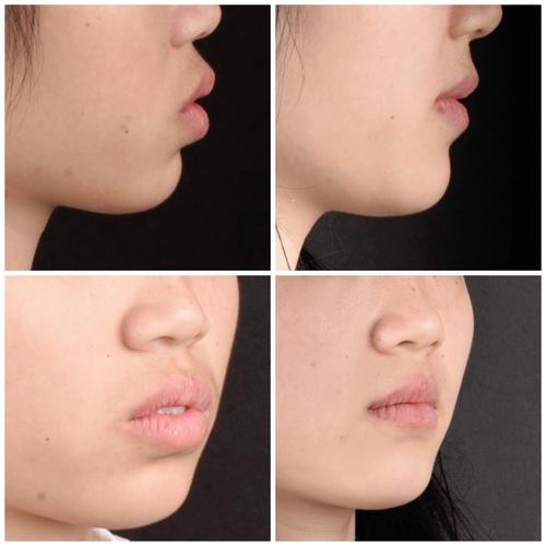 矫正牙齿脸变平-图1