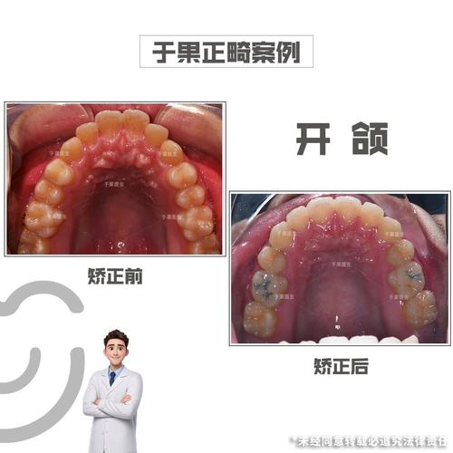 下巴响矫正牙齿-图1