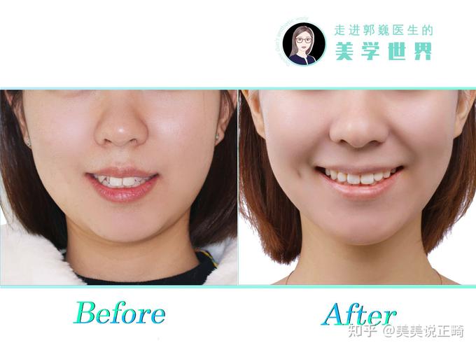 郑州矫正牙齿吧-图1