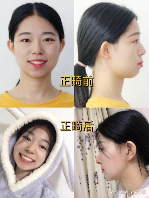 牙齿前突矫正怎么做？效果好吗？有哪些注意事项？要多久？-图1