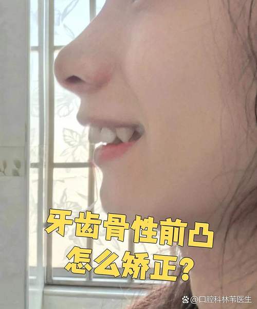 牙齿前突矫正怎么做？效果好吗？有哪些注意事项？要多久？-图2