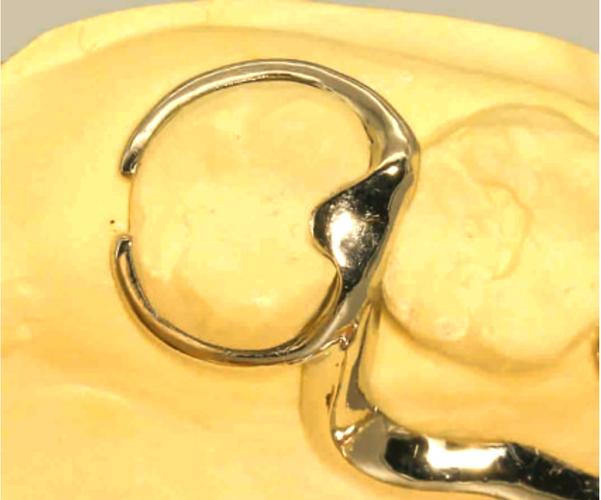 牙齿矫正上卡环-图1