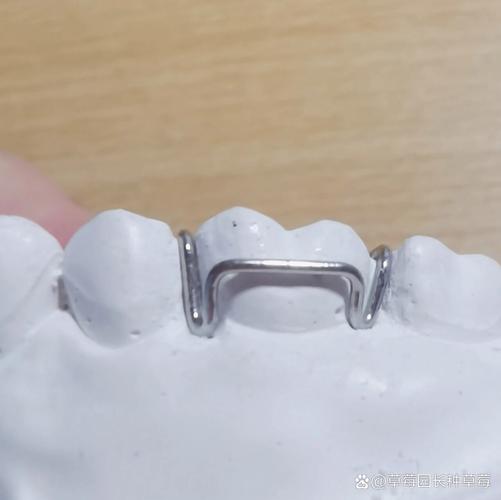 牙齿矫正上卡环-图2