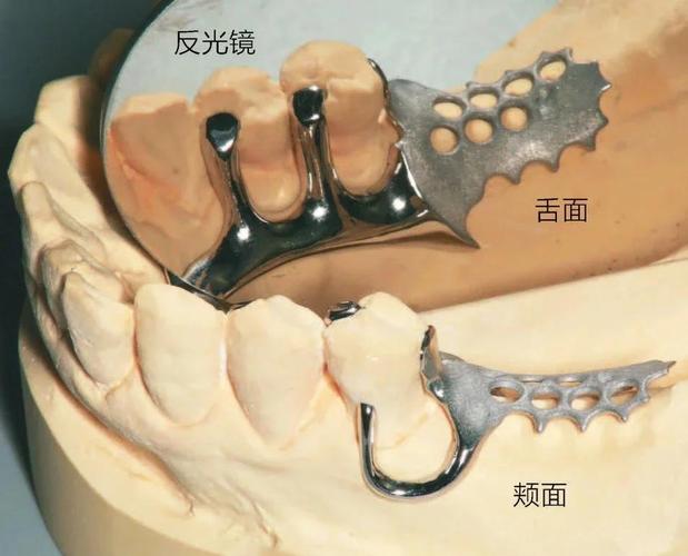 牙齿矫正上卡环-图3