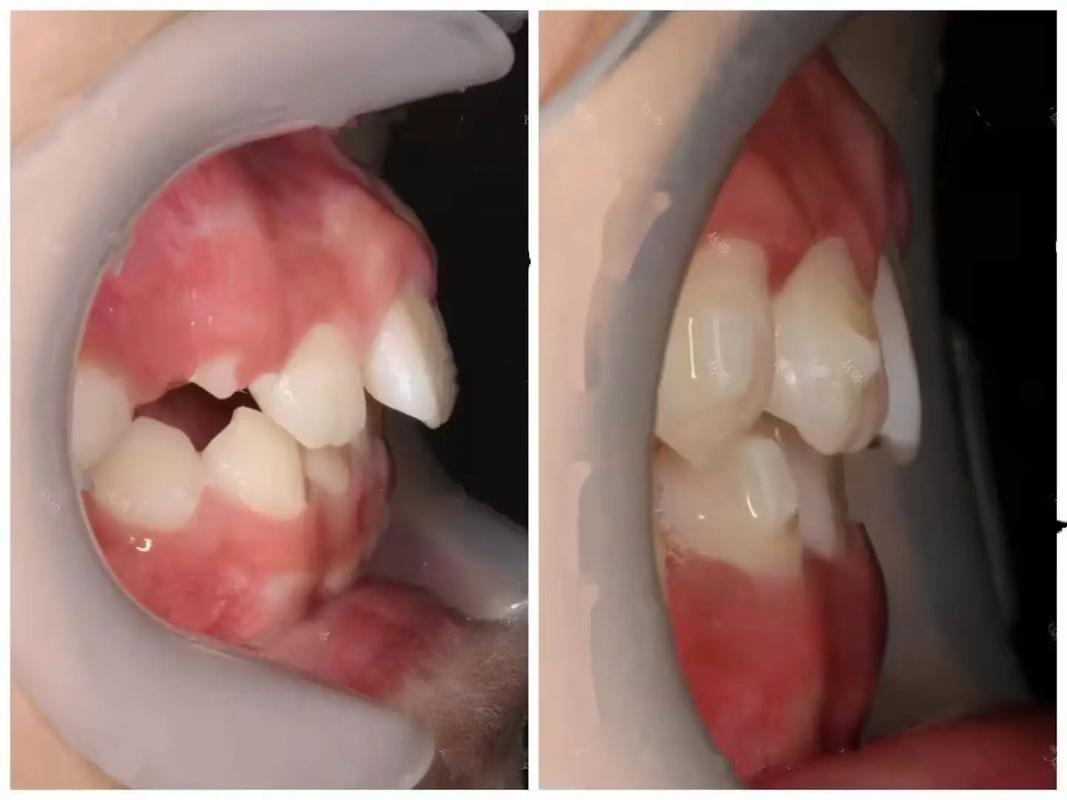 牙外突矫正牙齿-图3