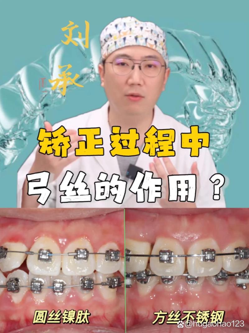 真丝弓牙齿矫正有何优势？效果如何？适合哪些情况？-图2