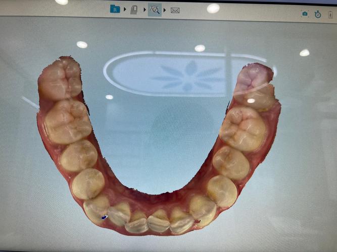 萧山牙齿矫正哪家好？效果如何？价格贵不贵？-图2