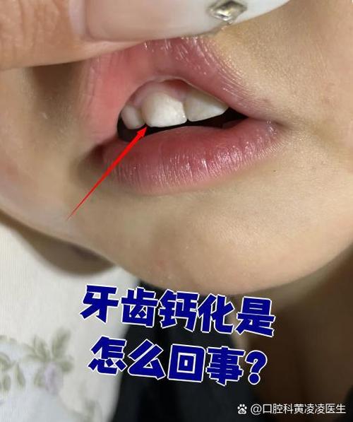 牙齿矫正后钙化-图1 牙齿矫正后钙化-图1