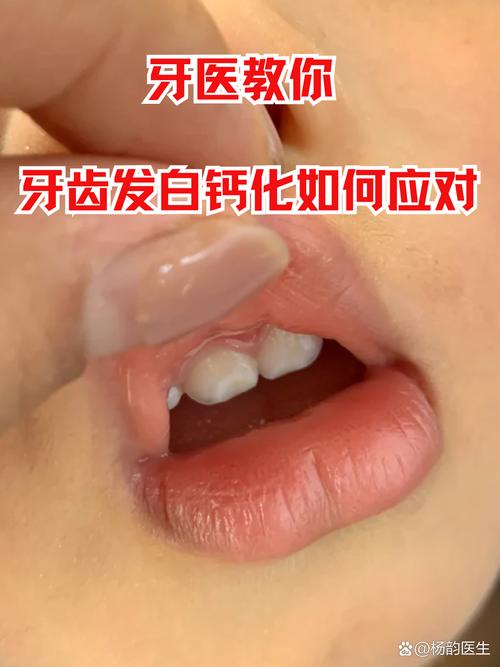 牙齿矫正后钙化-图2 牙齿矫正后钙化-图2