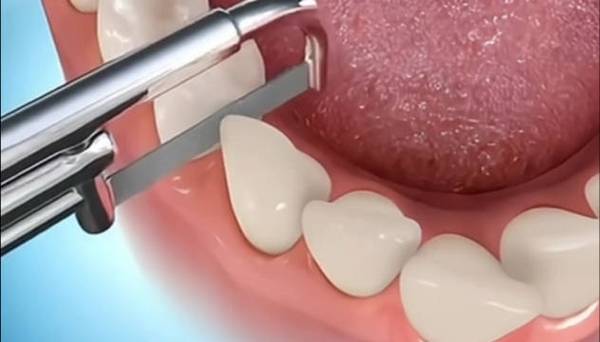 矫正牙齿为何要做片切牙？对牙齿有伤害吗？-图1