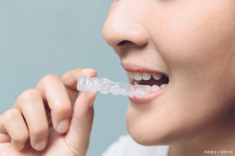 隐形矫正牙齿r-图3