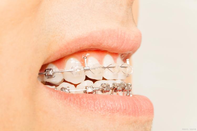 牙齿矫正有假牙-图2 牙齿矫正有假牙-图2