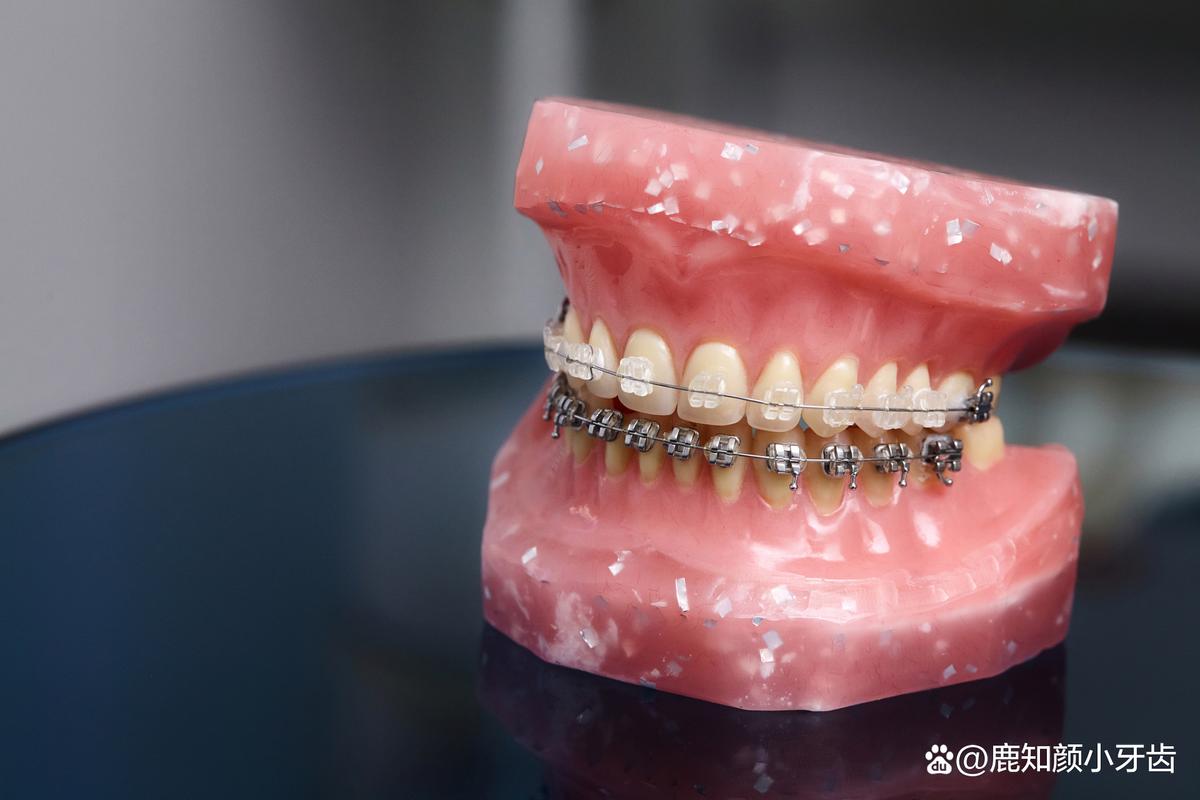 牙齿矫正x照片-图2 牙齿矫正x照片-图2