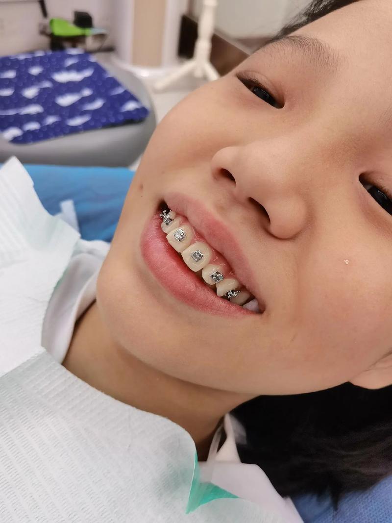 小朋友牙齿矫正,几岁开始最合适?需要拔牙吗?过程疼不疼?-图2 小朋友牙齿矫正,几岁开始最合适?需要拔牙吗?过程疼不疼?-图2