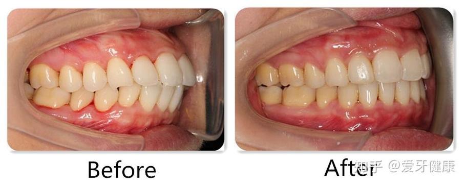 矫正牙齿失败，问题究竟出在哪？-图1
