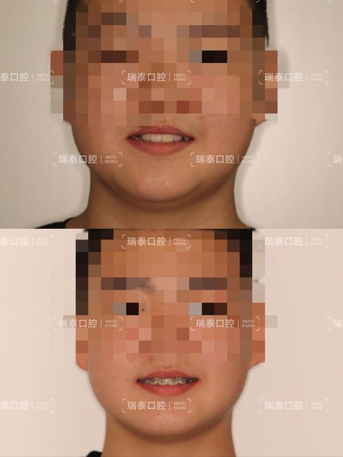 牙齿矫正自信了-图1 牙齿矫正自信了-图1