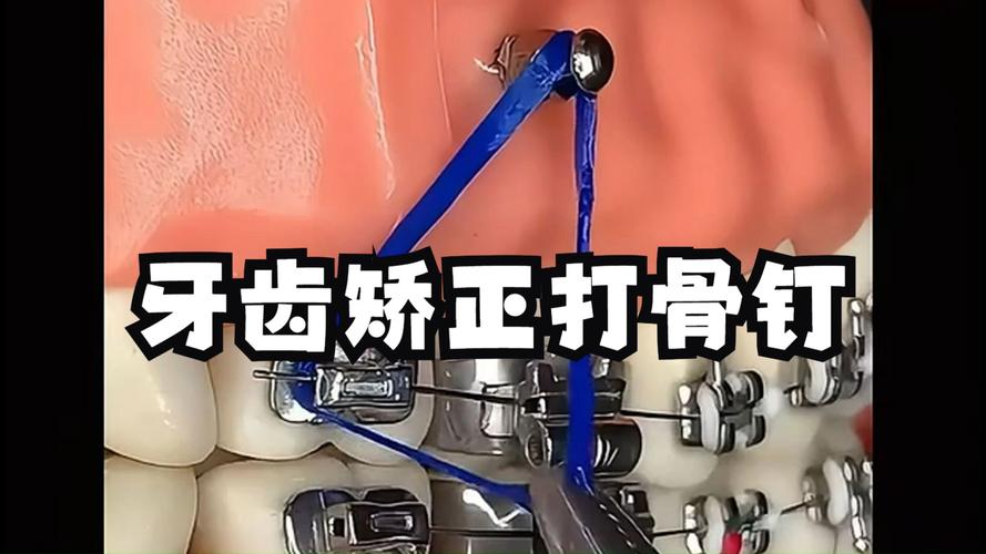 牙齿矫正拆钉子-图1